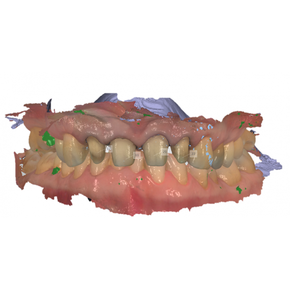 Zirconio Plus multistrato da impronta digitale(consigliato per monolitiche)