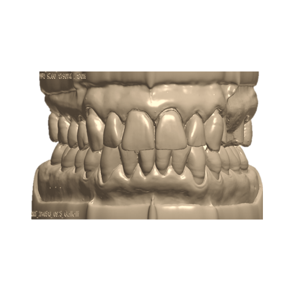 Zirconio Base monostrato da modello(consigliato per strutture)