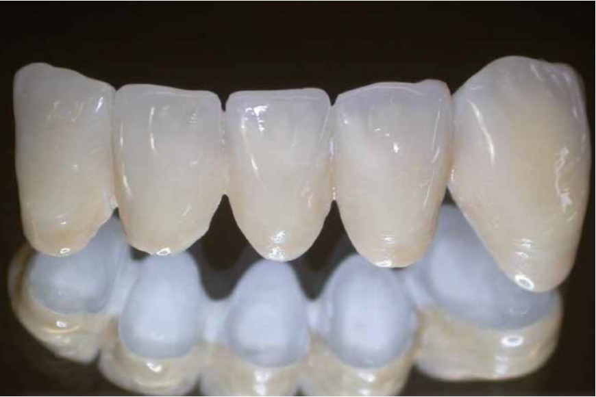 Peek dentale: polimero ad alte prestazioni