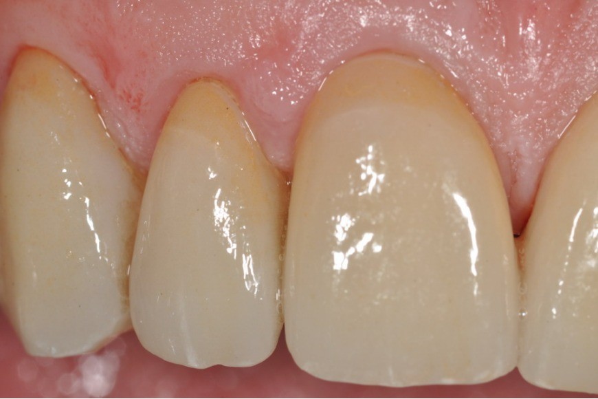 Faccette dentali online: semilavorati in disilicato di litio