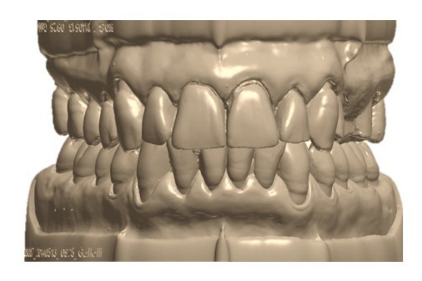 Protesi dentarie fisse: materiali e semilavorati 
