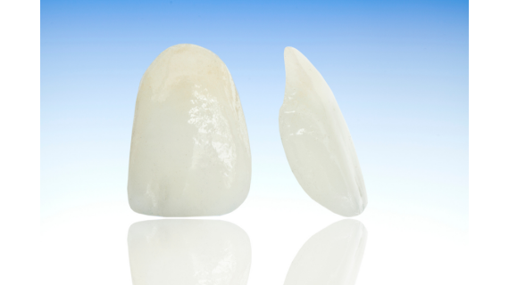 Veneers denti: caratteristiche e materiali