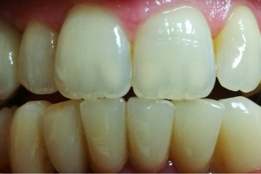 Cemento Dentale Dengen Dental Dengocem 2 Per Restauri E Fissaggio Corone - copertina